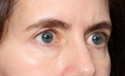 Blepharoplasty Before & After Patient #34395