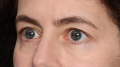 Blepharoplasty Before & After Patient #34395