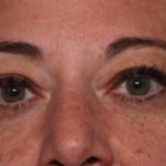 Blepharoplasty Before & After Patient #34557