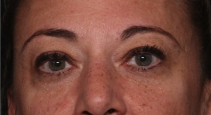 Blepharoplasty Before & After Patient #34557