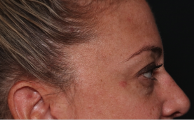 Blepharoplasty Before & After Patient #34557