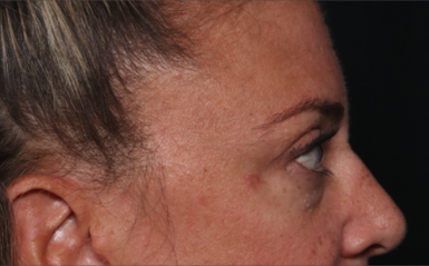 Blepharoplasty Before & After Patient #34557