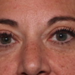 Blepharoplasty Before & After Patient #34557