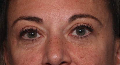 Blepharoplasty Before & After Patient #34557