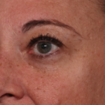 Blepharoplasty Before & After Patient #34557