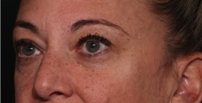 Blepharoplasty Before & After Patient #34557