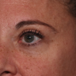 Blepharoplasty Before & After Patient #34557