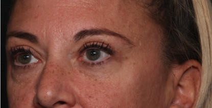 Blepharoplasty Before & After Patient #34557