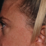 Blepharoplasty Before & After Patient #34557