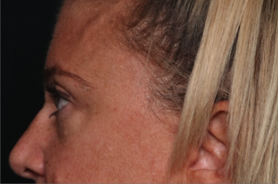 Blepharoplasty Before & After Patient #34557