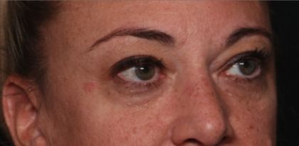 Blepharoplasty Before & After Patient #34557