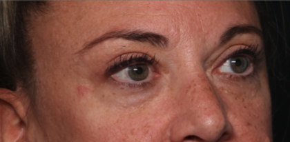 Blepharoplasty Before & After Patient #34557