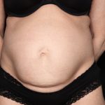 Tummy Tuck Before & After Patient #34546