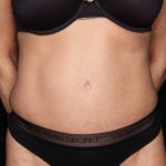 Tummy Tuck Before & After Patient #34546