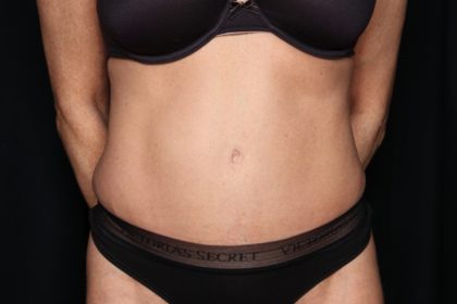 Tummy Tuck Before & After Patient #34546