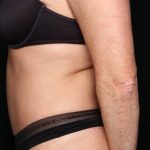 Tummy Tuck Before & After Patient #34546