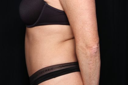 Tummy Tuck Before & After Patient #34546