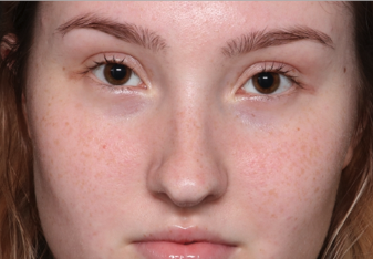 Rhinoplasty Before & After Patient #34592