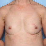 Breast Augmentation Before & After Patient #34601