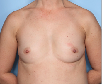 Breast Augmentation Before & After Patient #34601