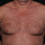 Gynecomastia Before & After Patient #34603