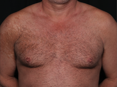 Gynecomastia Before & After Patient #34603