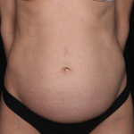 Tummy Tuck Before & After Patient #34604