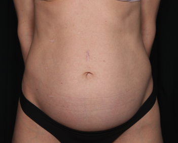 Tummy Tuck Before & After Patient #34604