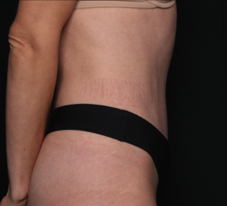 Tummy Tuck Before & After Patient #34604