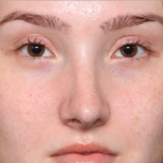 Rhinoplasty Before & After Patient #34592