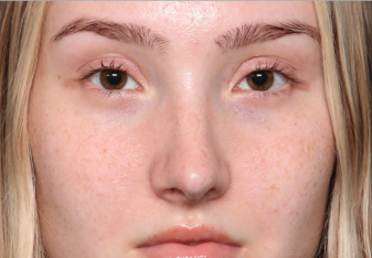 Rhinoplasty Before & After Patient #34592