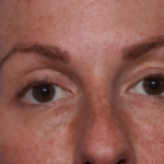 Injectable Fillers Before & After Patient #34602