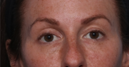 Injectable Fillers Before & After Patient #34602