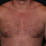 Gynecomastia Before & After Patient #34603