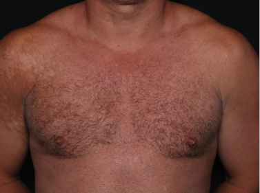 Gynecomastia Before & After Patient #34603