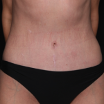 Tummy Tuck Before & After Patient #34604