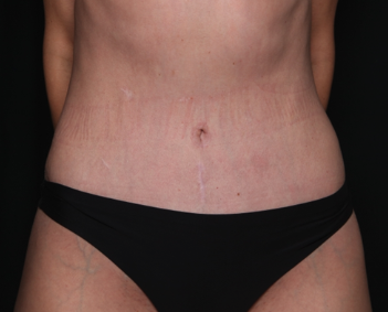 Tummy Tuck Before & After Patient #34604