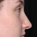 Rhinoplasty Before & After Patient #34592