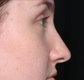 Rhinoplasty Before & After Patient #34592