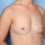 Breast Augmentation Before & After Patient #34601