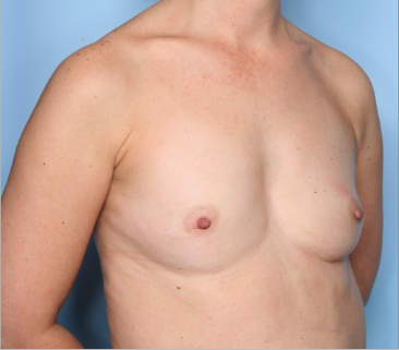 Breast Augmentation Before & After Patient #34601