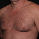 Gynecomastia Before & After Patient #34603