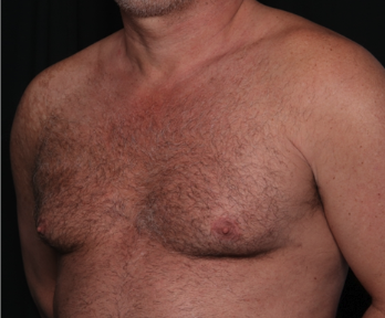 Gynecomastia Before & After Patient #34603