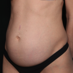 Tummy Tuck Before & After Patient #34604