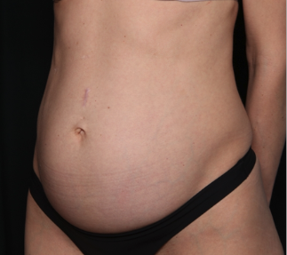 Tummy Tuck Before & After Patient #34604