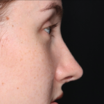 Rhinoplasty Before & After Patient #34592