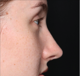 Rhinoplasty Before & After Patient #34592