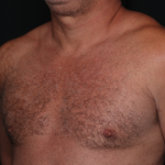 Gynecomastia Before & After Patient #34603