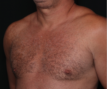 Gynecomastia Before & After Patient #34603