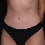 Tummy Tuck Before & After Patient #34604